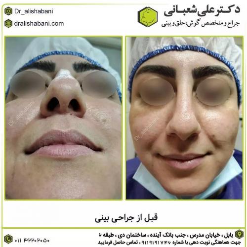 جراحی-بینی-در-بابل190