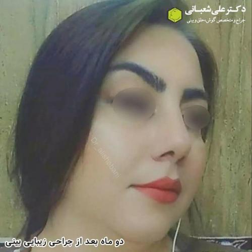 جراحی-بینی-در-بابل191