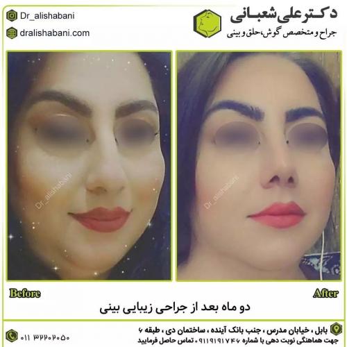 جراحی-بینی-در-بابل192