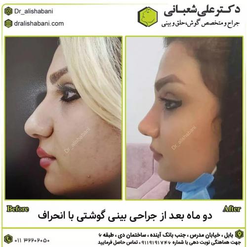 جراحی-بینی-در-بابل193
