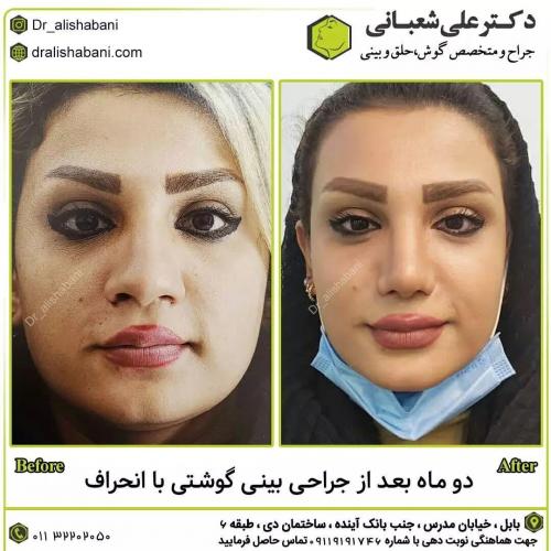جراحی-بینی-در-بابل194