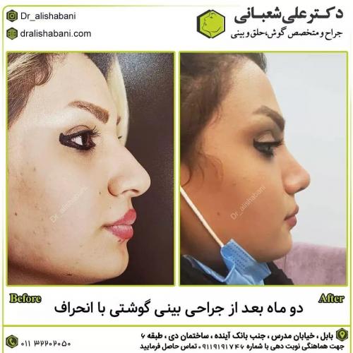جراحی-بینی-در-بابل195