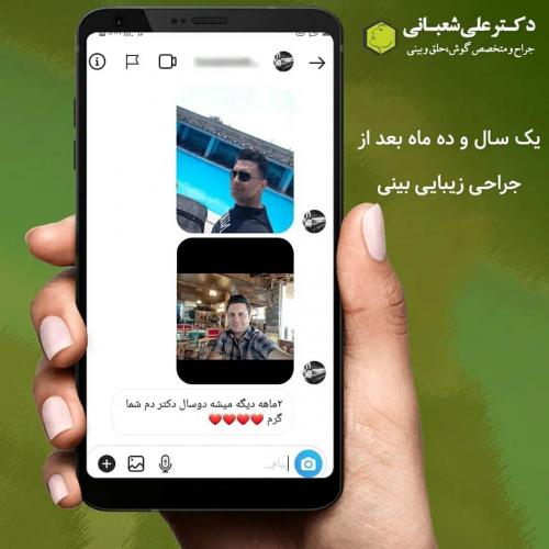 جراحی-بینی-در-بابل196