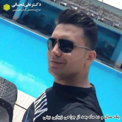 جراحی-بینی-در-بابل198