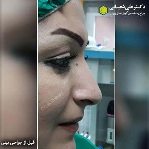 جراحی-بینی-در-بابل200