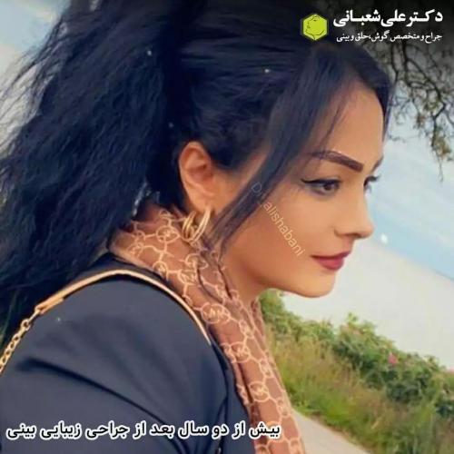 جراحی-بینی-در-بابل201