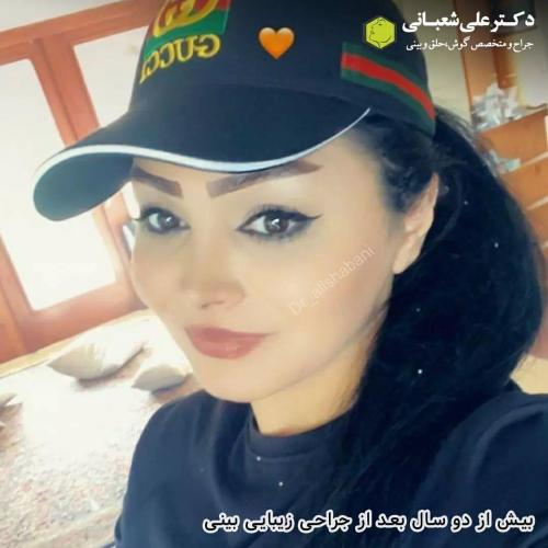 جراحی-بینی-در-بابل202