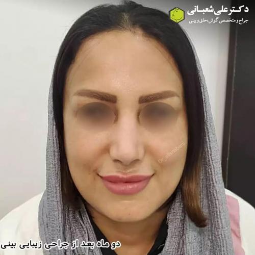 جراحی-بینی-در-بابل206