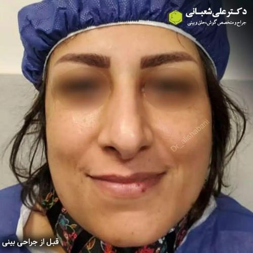جراحی-بینی-در-بابل207