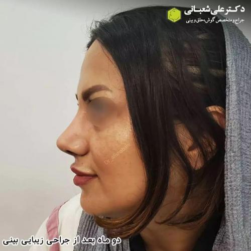 جراحی-بینی-در-بابل208