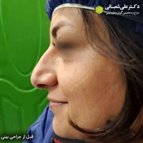 جراحی-بینی-در-بابل209