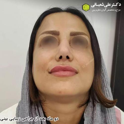 جراحی-بینی-در-بابل210