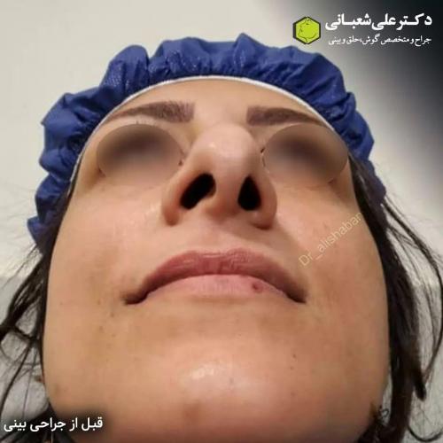 جراحی-بینی-در-بابل211