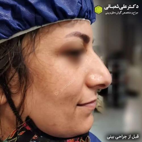 جراحی-بینی-در-بابل212