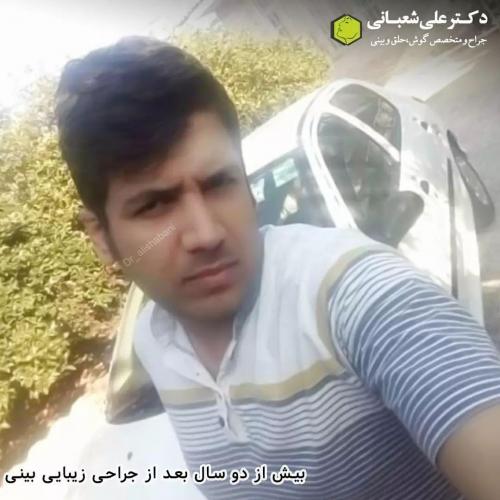 جراحی-بینی-در-بابل214