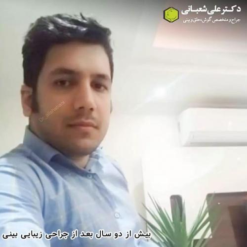 جراحی-بینی-در-بابل216