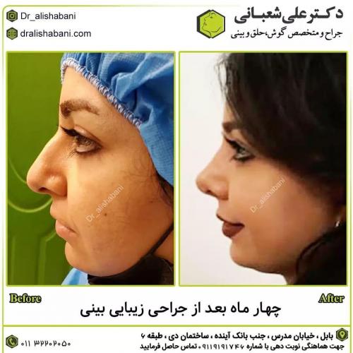 جراحی-بینی-در-بابل217