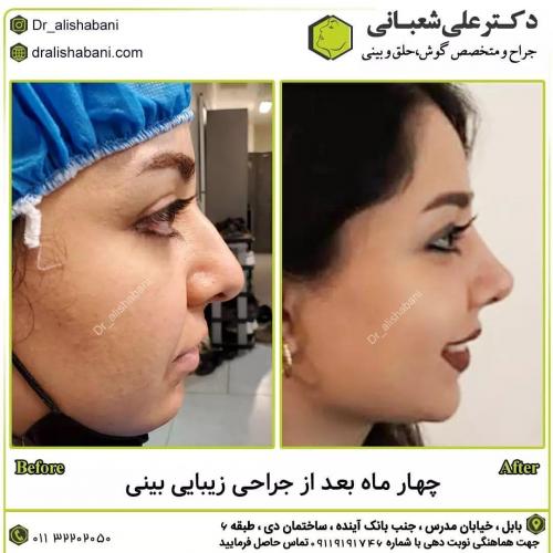 جراحی-بینی-در-بابل218