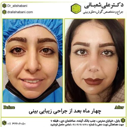 جراحی-بینی-در-بابل219