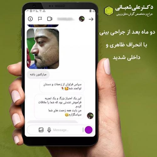 جراحی-بینی-در-بابل220