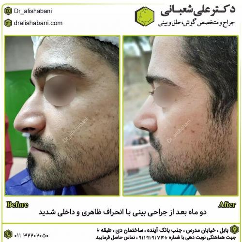 جراحی-بینی-در-بابل221
