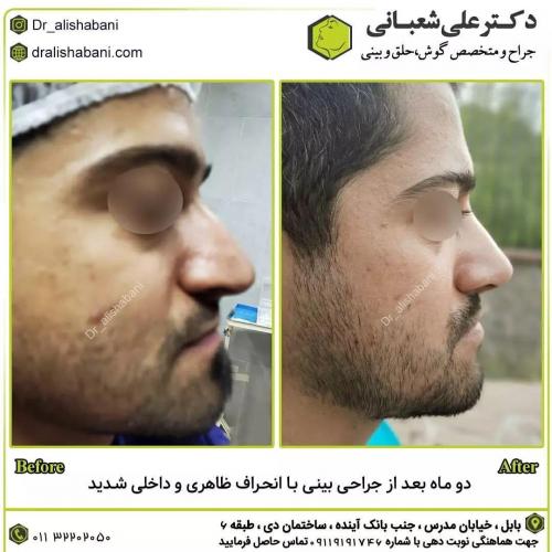 جراحی-بینی-در-بابل222