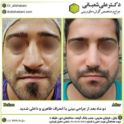 جراحی-بینی-در-بابل223