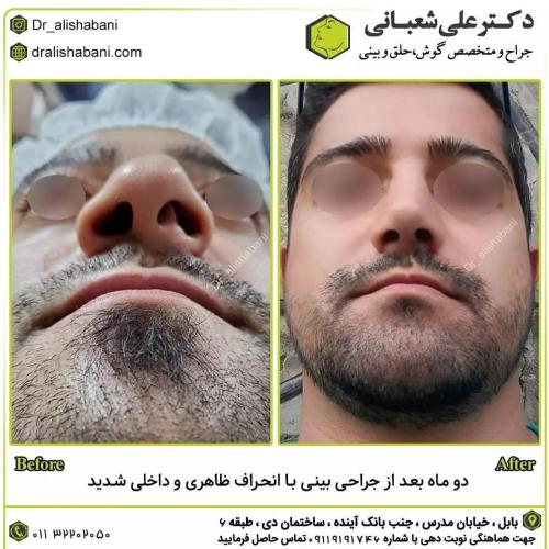 جراحی-بینی-در-بابل224