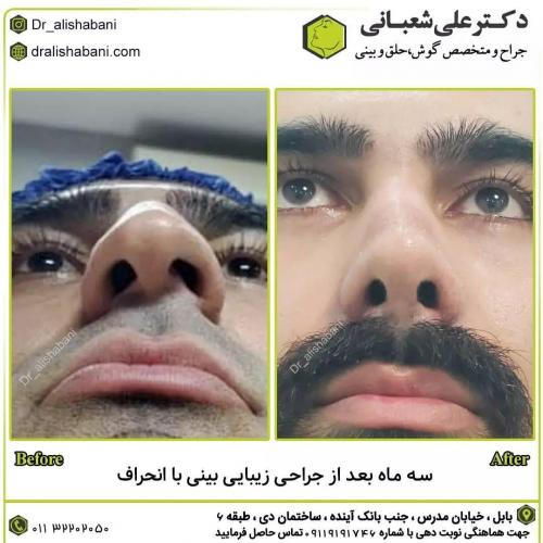 جراحی-بینی-در-بابل225