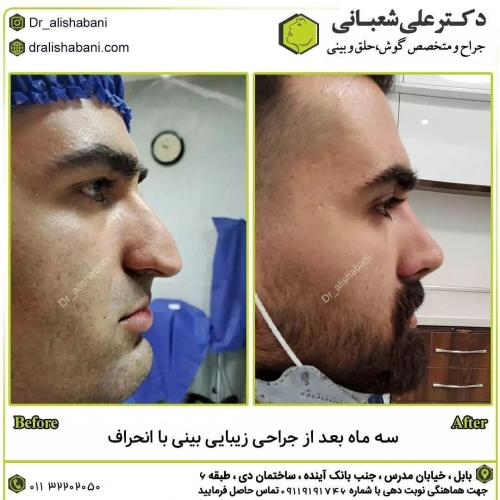 جراحی-بینی-در-بابل226