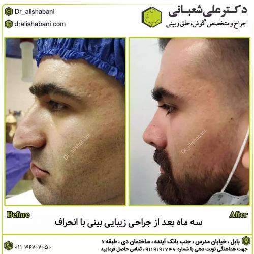 جراحی-بینی-در-بابل227
