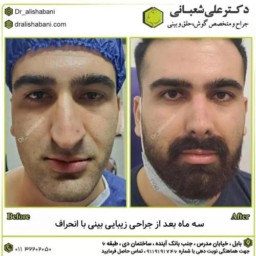 جراحی-بینی-در-بابل228