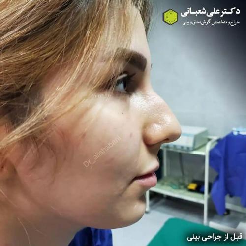 جراحی-بینی-در-بابل230