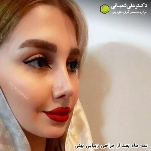 جراحی-بینی-در-بابل231