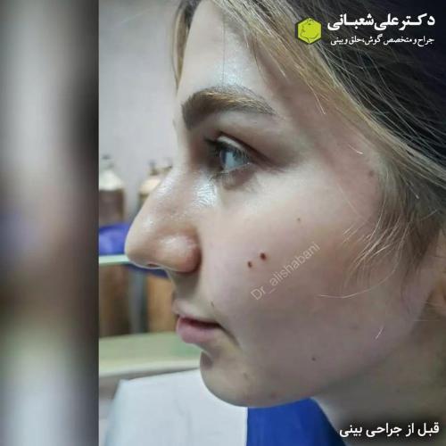 جراحی-بینی-در-بابل232