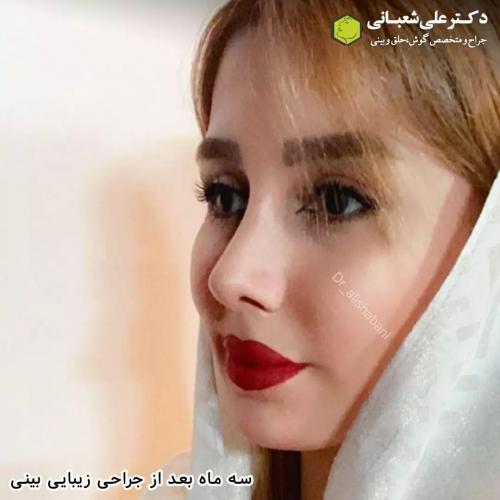 جراحی-بینی-در-بابل233