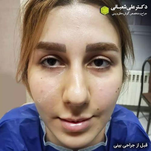 جراحی-بینی-در-بابل234