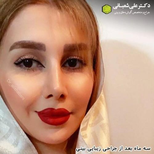 جراحی-بینی-در-بابل235