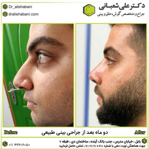 جراحی-بینی-در-بابل240