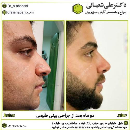 جراحی-بینی-در-بابل241