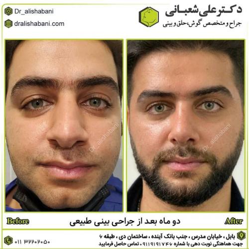 جراحی-بینی-در-بابل242