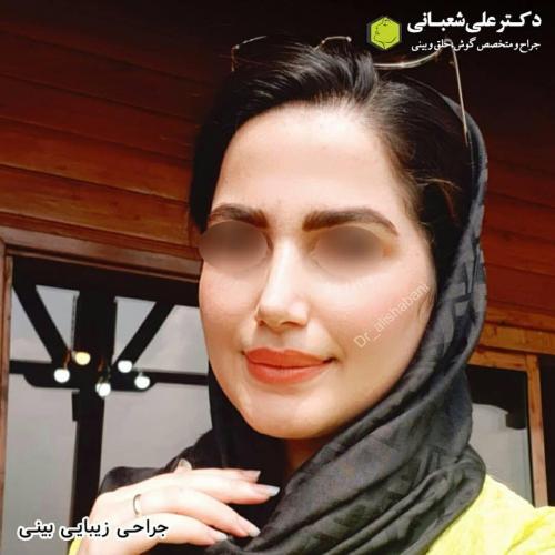 جراحی-بینی-در-بابل243