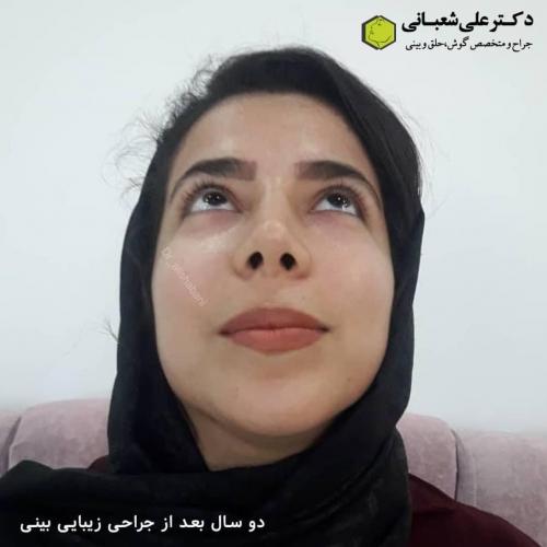 جراحی-بینی-در-بابل244
