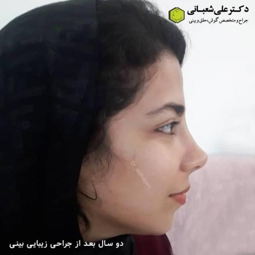 جراحی-بینی-در-بابل245