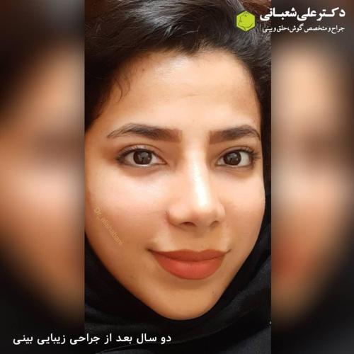جراحی-بینی-در-بابل246
