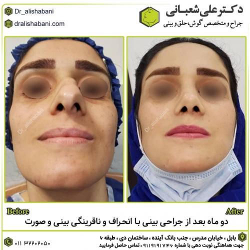جراحی-بینی-در-بابل247