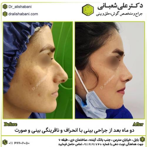 جراحی-بینی-در-بابل248