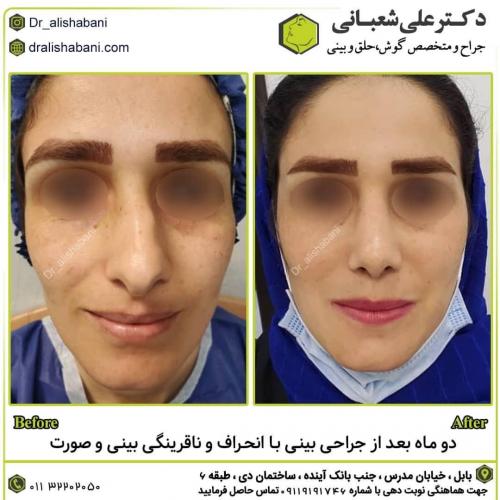 جراحی-بینی-در-بابل249