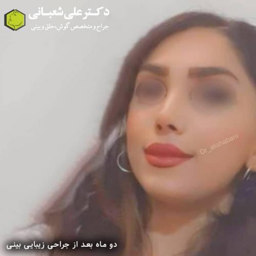 جراحی-بینی-در-بابل250