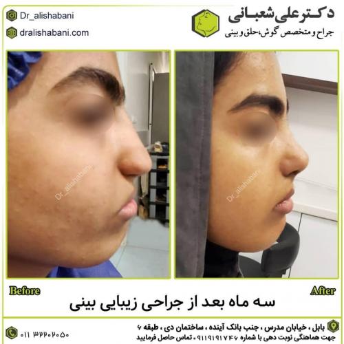 جراحی-بینی-در-بابل251